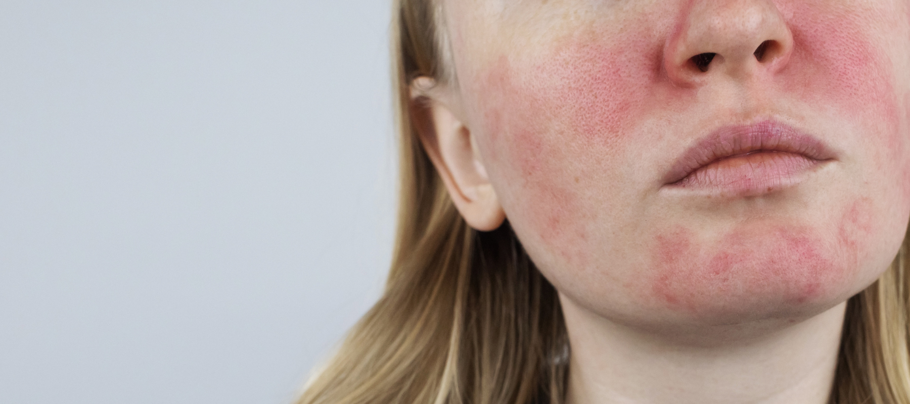 Rosacea Ernährung: So kannst Du Gesichtsrötung loswerden