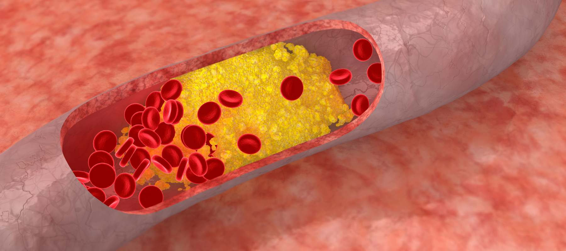 Cholesterin senken Ernährung – Zu hohen Cholesterinspiegel senken mit diesen Tipps