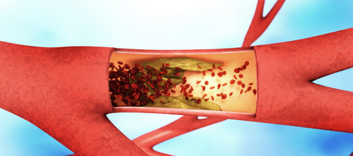 Arteriosklerose Ernährung: So kannst Du Atherosklerose vorbeugen und stoppen